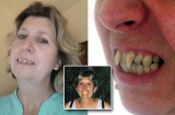 Choáng váng người phụ nữ có hàm răng ma cà rồng