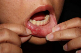 Nguyên nhân và cách điều trị nhiệt miệng ở người lớn