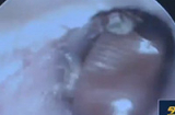 Kinh hoàng: Cận cảnh gắp 26 con gián ra khỏi tai người