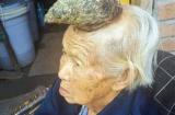 Kinh hãi cụ bà 87 tuổi mọc sừng “khủng” trên đầu