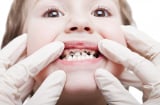 Những điều mẹ chưa biết về sâu răng ở trẻ nhỏ và cách phòng ngừa