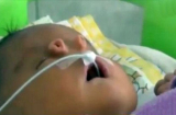 Xót xa bé trai chào đời với 4 lỗ mũi trên mặt