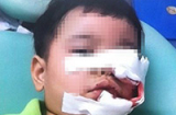 Xót xa: Bé trai 3 tuổi bị chó cắn nát mặt, khâu 200 mũi