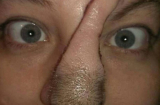 Kì lạ: Chiếc mũi có một không hai được cấy ghép từ da đầu