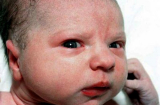 Nguy hiểm chết người khi tẩy lông tơ ở trẻ sơ sinh