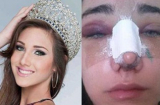 Tân Hoa hậu Quốc tế 2015 lộ ảnh nâng mũi, cắt mí