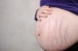 Những biến đổi ngoài da ở phụ nữ mang thai