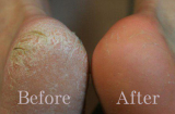 Cách chữa nứt gót chân siêu dễ mà bạn chưa biết