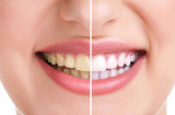 2 cách lấy cao răng tại nhà an toàn bắt buộc phải nhớ