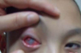 Cậu bé 10 tuổi bị mù vì trót nghịch đèn laser