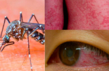 Virut zika - cách bắt bệnh và phòng ngừa hiệu quả nhất!