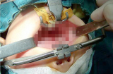 Xót xa bé 1 tuổi bị thương nặng do cục pin phát nổ trong miệng