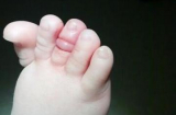 Trẻ có thể mất ngón chân, ngón tay chỉ từ một sợi tóc