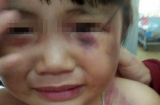 Bé gái 3 tuổi bị cha dượng đánh dã man để ‘trả thù’!