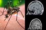 2 bệnh nhân Việt Nam nhiễm virus Zika là do muỗi truyền