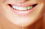 Loại bỏ cao răng siêu tốc chỉ 1 phút, sở hữu nụ cười không tỳ vết