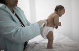 Khẳng định chắc chắn virus Zika khiến trẻ em mắc chứng teo não