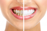 Răng trắng bất ngờ mà không cần chất tẩy