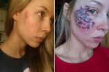 Thiếu nữ Mỹ bị phá hủy khuôn mặt vì tẩy vết bớt