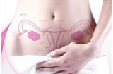 Những điều bạn cần biết về ung thư cổ tử cung