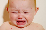 Dấu hiệu nhận biết khi trẻ bị sởi