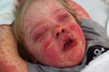 Khuôn mặt dị ứng đáng sợ của bé trai 3 tuổi do dùng kháng sinh
