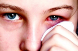 Cách xử lý bệnh đau mắt đỏ trong thời điểm giao mùa