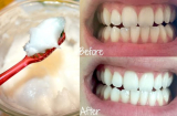 Thần dược giúp răng vàng cỡ nào cũng trở nên trắng bóc chỉ với 1 lần sử dụng