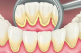 1 quả chanh lấy sạch toàn bộ cao răng mà không cần đi nha sỹ