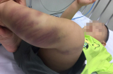 Hà Nội: Bé trai hơn 1 tuổi nghi bị bạo hành, nhập viện trong tình trạng bầm dập, tổn thương vùng sinh dục