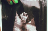 Thai nhi 20 tuần tuổi giơ bàn tay năm ngón tạo dáng như đang vẫy chào trong bụng mẹ