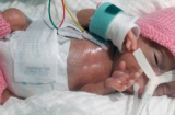 Sự sống sót kỳ diệu của bé sơ sinh nhỏ nhất thế giới, nặng 220g với kích thước chỉ bằng 2 bàn tay