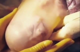 Kỳ diệu: Mẹ sinh mổ, bé vẫn nằm vo tròn trong túi ối