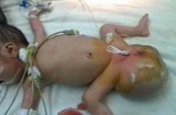 Bản tin phụ nữ 1/10: Phẫu thuật khối u quái cực lớn ở vùng cụt bé sơ sinh hai đầu