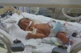 Mổ thai 28 tuần do mẹ bị tai nạn giao thông: Cháu bé đã có phản xạ đầu tiên