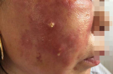 Kinh hoàng: Hai mẹ con nhập viện vì nhiễm trùng mặt nặng nề do tiêm thuốc trắng da