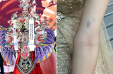Lộ danh tính mỹ nhân Việt bị ngã chấn thương đầu tại đấu trường sắc đẹp thế giới