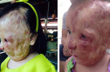 Xót xa em bé Việt mang khối u che gần nửa khuôn mặt may mắn nhận được sự cưu mang