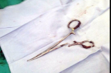 Chiếc kéo 15 cm 'bỏ quên' trong bụng bệnh nhân 18 năm được phẫu thuật lấy ra