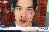 Diễn viên Thiên Nguyễn bị đánh trên đường phố Australia