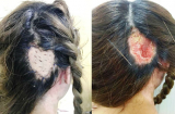 Cảnh báo: Hoại tử vành tai, mất da đầu khi hấp tóc đón Tết