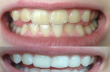 Răng trắng sáng gấp 8 lần trong vòng 2 phút nhờ 'thần dược' này