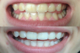 Loại bỏ cao răng mảng bám, răng trăng sáng bất ngờ nhờ thường xuyên làm điều này