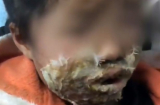 Bé gái 4 tuổi gào thét trong đau đớn, biến dạng vĩnh viễn gương mặt vì điện thoại bốc cháy