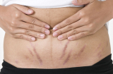 6 di chứng ghê gớm tàn phá cơ thể sau khi phụ nữ sinh con