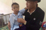 Hà Tĩnh: Đốt pin điện thoại, 2 anh em bị nổ nát tay