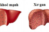 Có biểu hiện này hãy đi khám ngay kẻo ung thư gan mà không ngờ tới