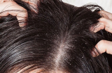 Top 5 cách trị gàu, rụng tóc cực rẻ cực hiệu quả chỉ sau 3 ngày sử dụng