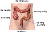 Dấu hiệu đầu tiên của bệnh ung thư đại trực tràng nhưng ít ai nghĩ mình mắc