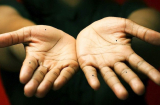 Nốt ruồi nằm trên các đốt ngón tay: VINH HOA PHÚ QUÝ hay BẦN HÀN CƠ CỰC?